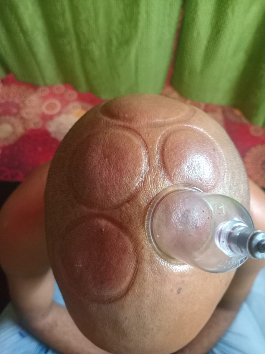 Cupping Therapy Treatment Photos
